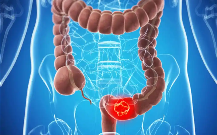 Kalın Bağırsak Kanseri Nedir, Nasıl Anlaşılır